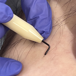 脚部分針挿入前全体