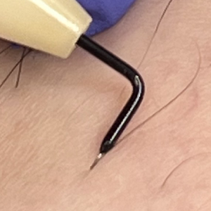 脚部分針挿入前針先