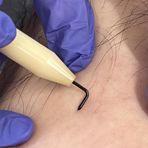 脚部分針挿入後全体