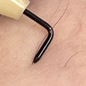 脚部分針挿入後針先