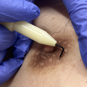 乳輪部針挿入前全体