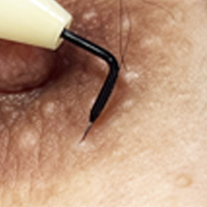 乳輪部針挿入前針先