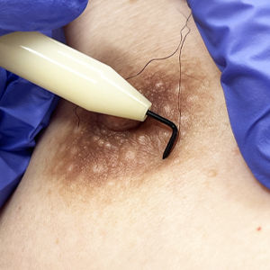 乳輪部針挿入後全体